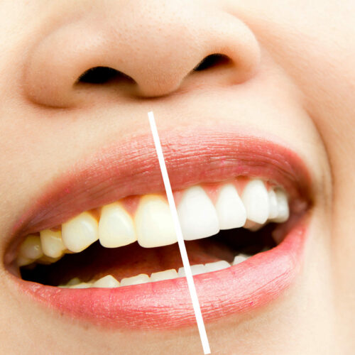 Utilize Zoom Whitening for optimal results!